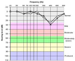 Moderate Hearing Loss